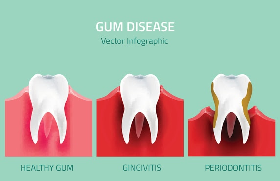 Gum disease infographic